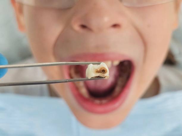 Best Emergency Wisdom Teeth Removal in Boulder, MT